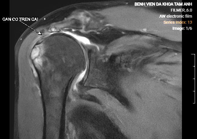 Phim chụp MRI của bà Vân cho thấy gân trên gai đứt hoàn toàn, co rút. Ảnh: Bệnh viện Đa khoa Tâm Anh
