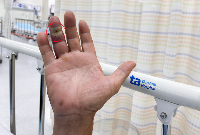 Ngón áp út tay phải của ông Tam tụ mủ sau hơn một tuần bị chó cưng cắn. Ảnh: Bệnh viện Đa khoa Tâm Anh