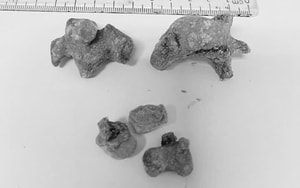 Người phụ nữ bị vòng tránh thai "đi lạc" vào bàng quang suốt 22 năm - Ảnh 3.