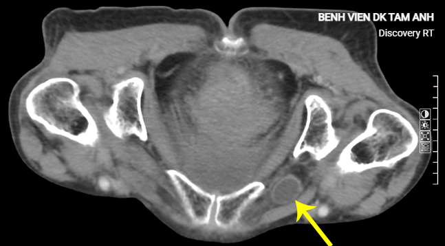 Quai ruột non phát vị qua lỗ bịt trên phim chụp CT. Ảnh: Bệnh viện Đa khoa Tâm Anh
