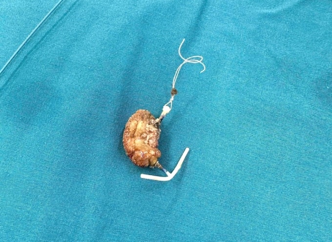 Vòng tránh thai đi lệch vào bàng quang được lấy ra. Ảnh: Bệnh viện đa khoa Cà Mau