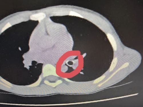 Bệnh nhi 7 tuổi bị dị vật đường hô hấp do thói quen nguy hiểm khi học bài - Ảnh 1.