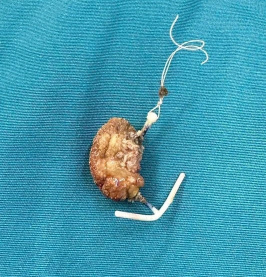 Người phụ nữ bị vòng tránh thai "đi lạc" vào bàng quang suốt 22 năm - Ảnh 3.