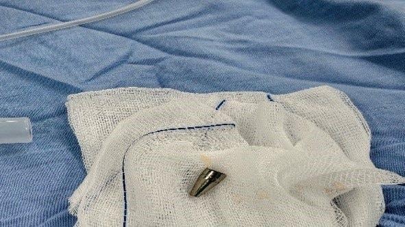 Bệnh nhi 7 tuổi bị dị vật đường hô hấp do thói quen nguy hiểm khi học bài - Ảnh 2.