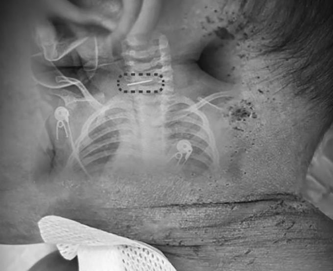 Bé trai 10 tháng tuổi có nhiều vết kim đâm khắp cơ thể. Ảnh: Red Star News