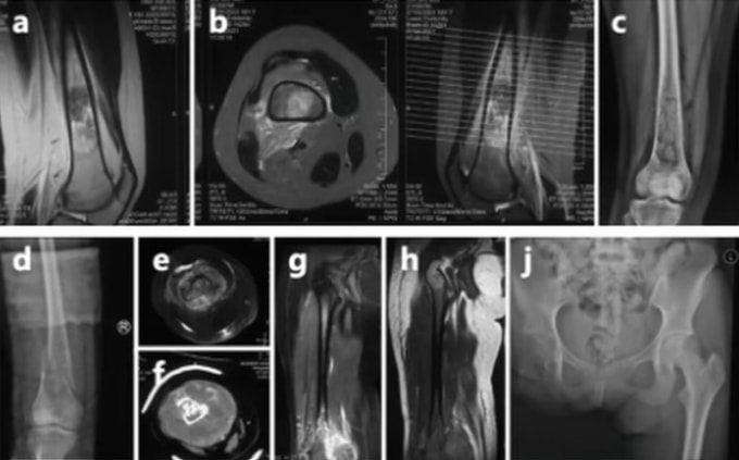 Phim chụp ung thư xương của Thế Vĩ. Ảnh: The Paper