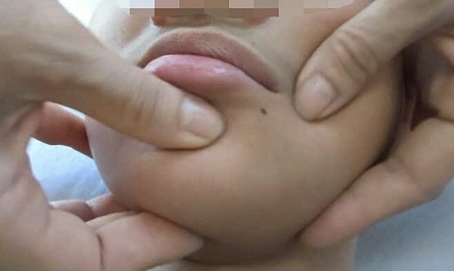 Một bệnh nhân trẻ bị liệt dây thần kinh số 7 do lạnh. Ảnh: Bệnh viện cung cấp