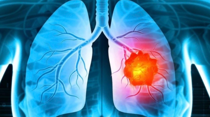 Minh họa khối u ung thư phổi. Ảnh: Johnson & Johnson