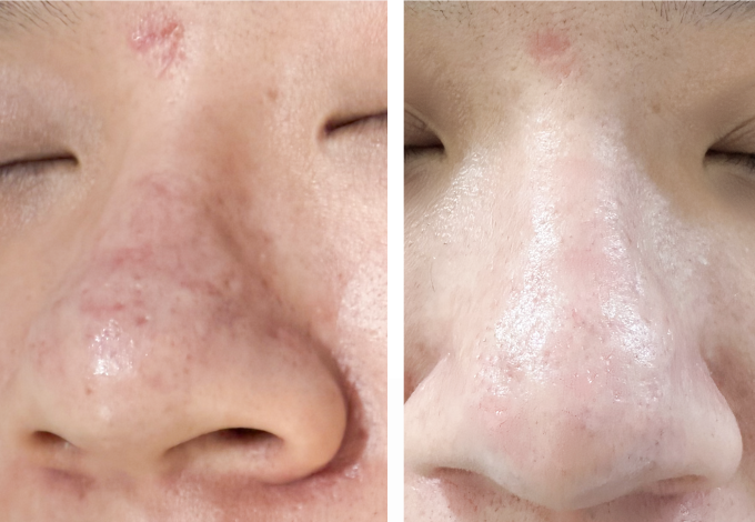 Các vết sẹo mụn quanh mũi của anh Hùng không còn xơ cứng, giảm đỏ sau 6 lần điều trị. Ảnh: Bệnh viện Đa khoa Tâm Anh