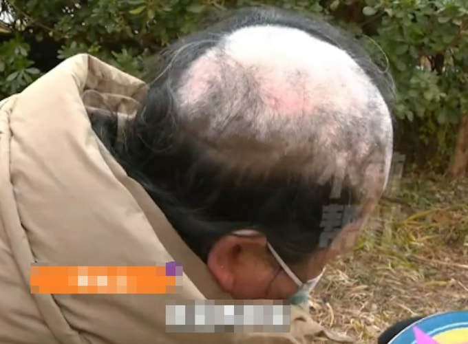 Lý để lộ mảng đầu hói do bệnh lý trong lúc trả lời phỏng vấn của phóng viên. Ảnh: Baidu