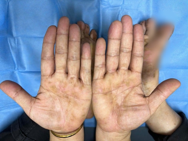 Da đỏ sậm, bong tróc khi trời lạnh, người phụ nữ Hà Nội phải cầu cứu bác sĩ- Ảnh 1.