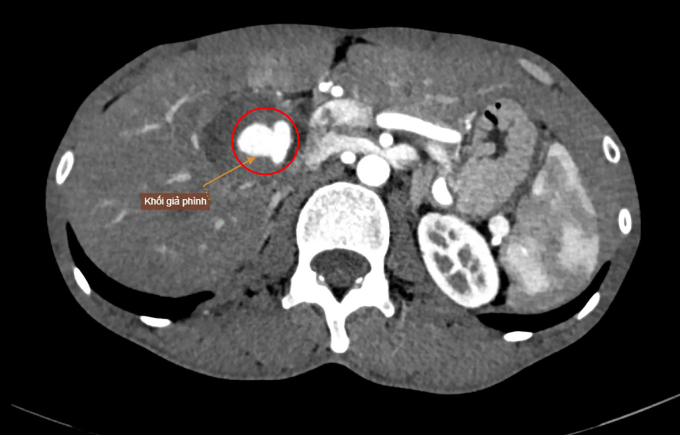 Khối giả phình lớn nguy cơ vỡ trên hình chụp CT. Ảnh: Bệnh viện Đa khoa Tâm Anh