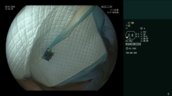 Bàn chải đánh răng được lấy ra từ dạ dày của người bệnh. Ảnh: Bệnh viện Đa khoa Tâm Anh