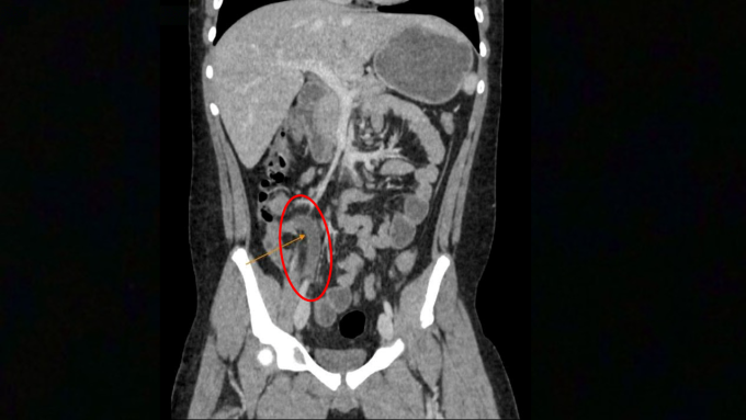 Hình ảnh CT cho thấy viêm ruột thừa kèm sỏi phân. Ảnh: Phòng khám Đa khoa Tâm Anh Quận 7