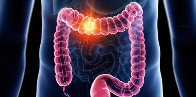 Mô phỏng khối u ung thư phát triển trong ruột bệnh nhân. Ảnh: Diabetes