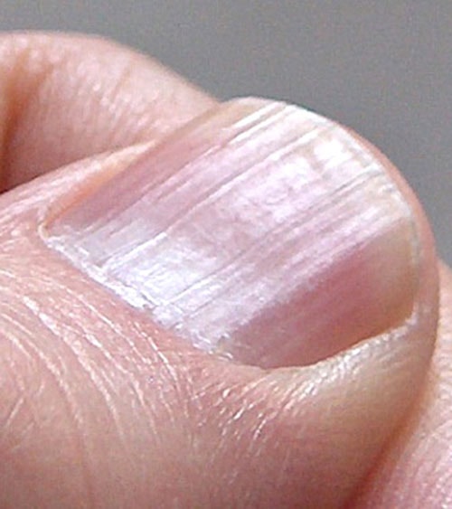 Móng tay nổi sọc dọc, cảnh báo dấu hiệu bất thường vấn đề sức khỏe - Ảnh 3.