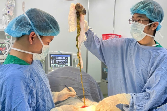 Các bác sĩ phẫu thuật lấy khối tóc ra khỏi dạ dày bé trai. Ảnh: Tú Anh