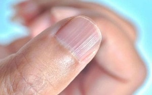 5 dấu hiệu nhận biết nốt ruồi có nguy cơ ác tính, ung thư, nhất cái số 1 không phải ai cũng biết - Ảnh 2.