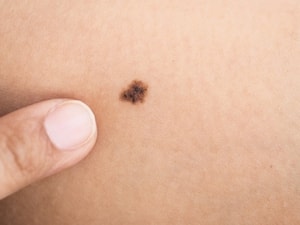 5 dấu hiệu nhận biết nốt ruồi có nguy cơ ác tính, ung thư, nhất cái số 1 không phải ai cũng biết - Ảnh 4.