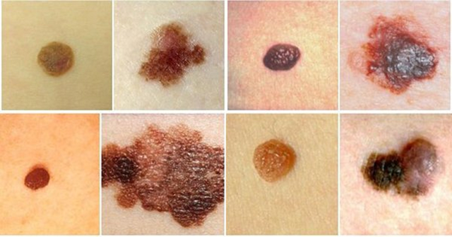 5 dấu hiệu nhận biết nốt ruồi có nguy cơ ác tính, ung thư, nhất cái số 1 không phải ai cũng biết - Ảnh 1.