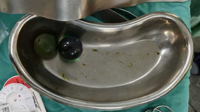 Bé gái 18 tháng tuổi nôn ói nguy kịch, bác sĩ gắp ra thứ "đáng sợ" trong bụng - Ảnh 1.