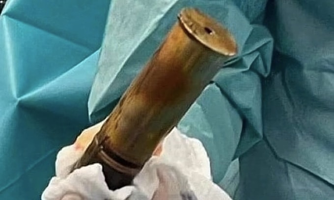 Quả đạn pháo được lấy ra từ cơ thể bệnh nhân tại Bệnh viện Sainte-Musse hồi năm 2022. Ảnh: Acommonlawyer