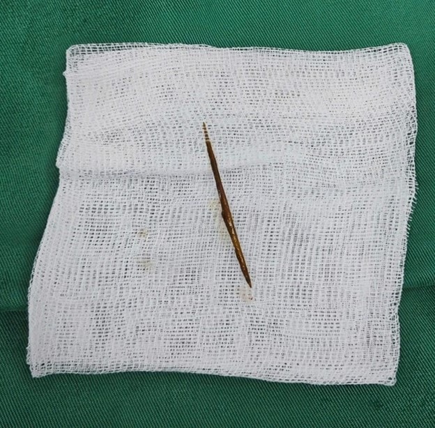 Người đàn ông bị thủng ruột vì một sai lầm gây nguy hiểm tính mạng - Ảnh 2.