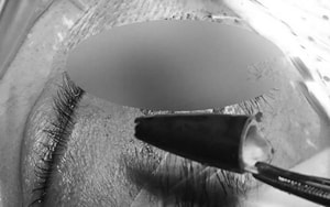 Người đàn ông bị thủng ruột vì một sai lầm gây nguy hiểm tính mạng - Ảnh 3.