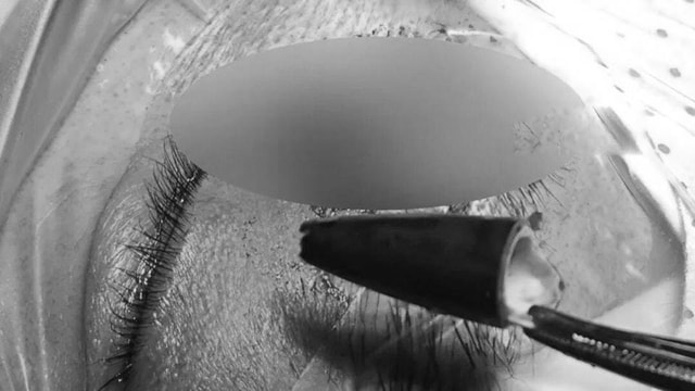 Người đàn ông đau mắt dữ dội, bác sĩ lấy ra thứ "đáng sợ" bên trong - Ảnh 1.