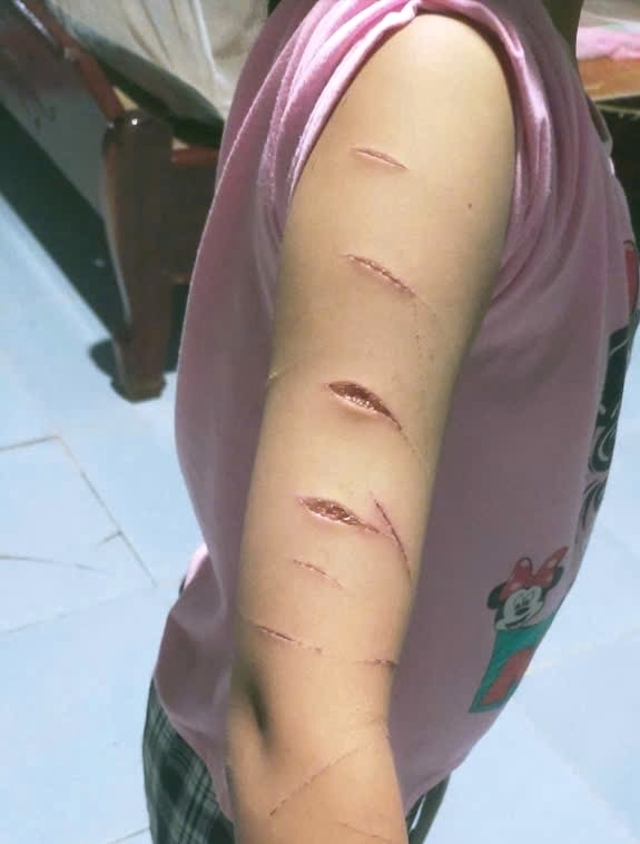 Những vết thương trên cánh tay của bé gái. Ảnh: Gia đình cung cấp