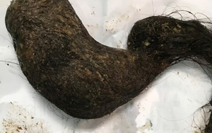 Ăn cơm có cảm giác nuốt vướng, người đàn ông sốc khi phát hiện 3 bệnh ung thư cùng lúc - Ảnh 4.