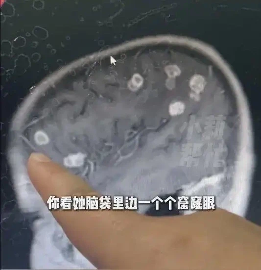 Những lỗ hổng bị nấm ăn trong não bé gái 6 tuổi, sau khi dọn nhà đón Tết với gia đình. Ảnh: Qianjiang Evening News