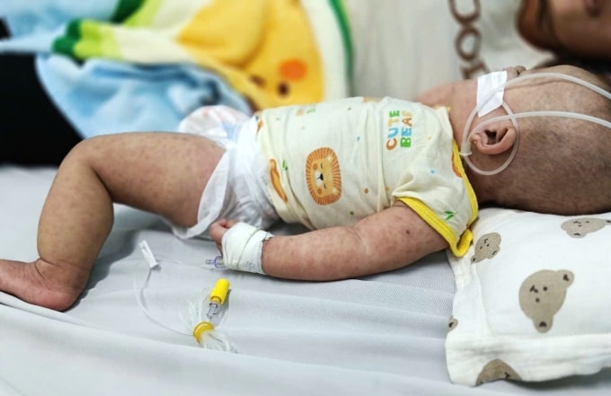 Một bệnh nhi phải nhập viện điều trị do sởi tại Bệnh viện Nhi đồng 1. Ảnh: Khánh Hòa