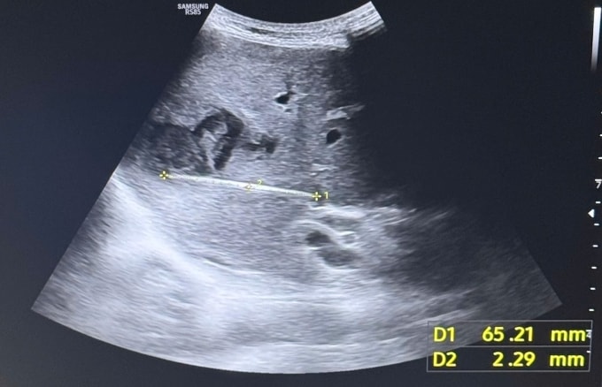 Hình ảnh cây tăm trên siêu âm. Ảnh: Bệnh viện cung cấp