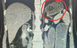 Người đàn ông đau bụng kéo dài, bác sĩ sốc khi phát hiện bí mật bên trong - Ảnh 6.