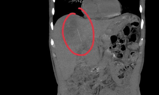 Người đàn ông đau bụng kéo dài, bác sĩ sốc khi phát hiện bí mật bên trong - Ảnh 2.
