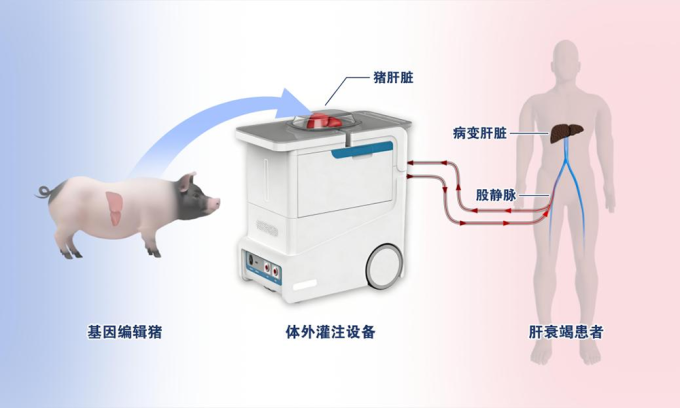 Sơ đồ mô phỏng liệu pháp tưới máu ngoài cơ thể bằng gan lợn chỉnh sửa 6 gene. Ảnh: Xijing Hospital