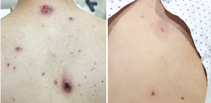 Tình trạng của người bệnh trước (bên trái) và sau khi điều trị. Ảnh: Bệnh viện Đa khoa Tâm Anh