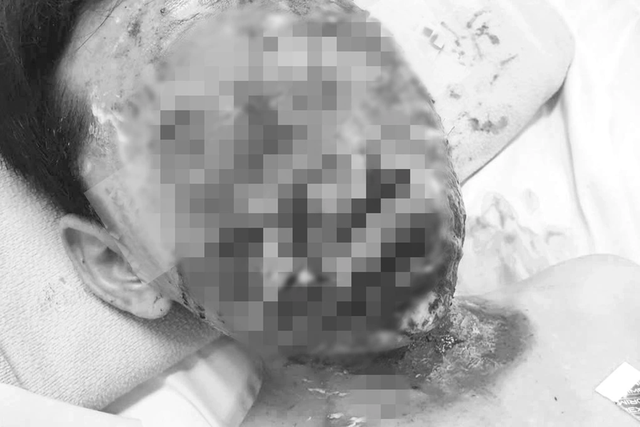 Mối hiểm họa từ pháo tự chế lại gia tăng: Một tiếng nổ cho vui, cả đời trả giá - Ảnh 1.