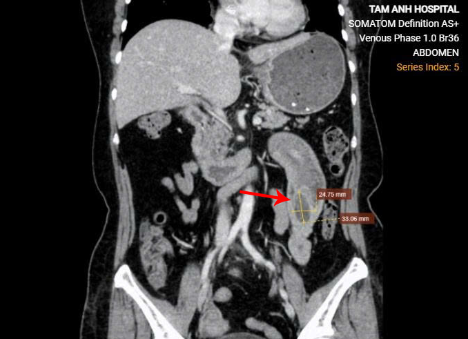 Khối u gây lồng 30 cm ruột non của bà Thủy trên phim chụp CT. Ảnh: Bệnh viện Đa khoa Tâm Anh