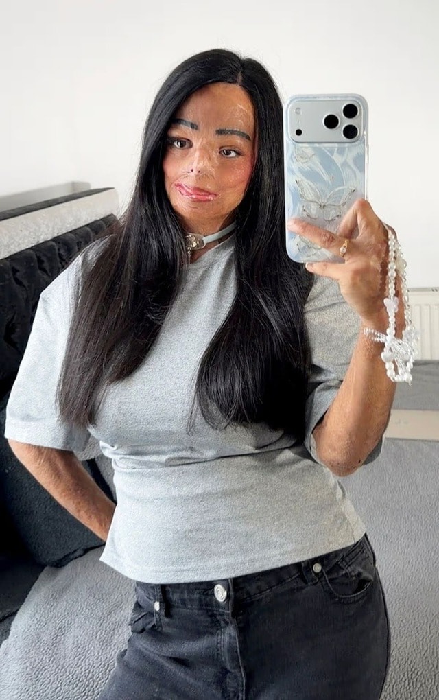 Dầu gội đầu bắt lửa, cô gái xinh đẹp bị bỏng nửa người và cái kết bất ngờ- Ảnh 1. Dầu gội đầu bắt lửa, cô gái xinh đẹp bị bỏng nửa người và cái kết bất ngờ- Ảnh 1.