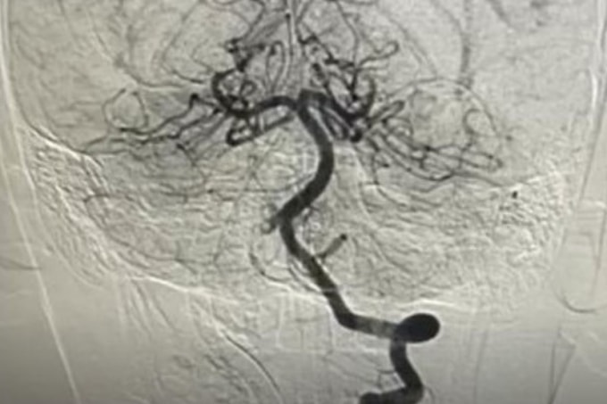 Bác sĩ can thiệp tái thông mạch máu cho bệnh nhi. Ảnh: Bệnh viện cung cấp