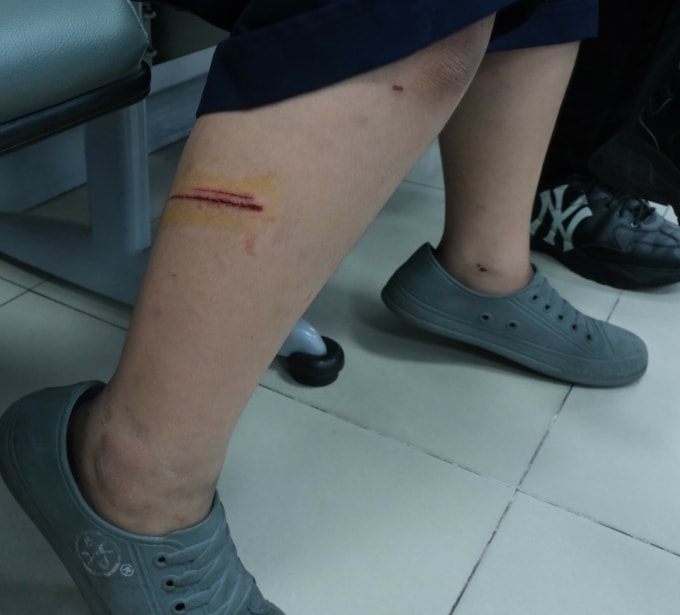 Vết thương ở chân con trai chị Vân. Ảnh: Hoàng Dương