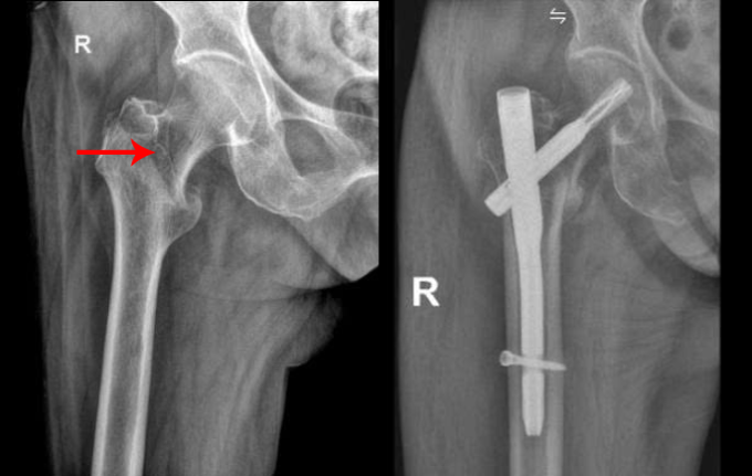 Ổ gãy liên mấu chuyển xương đùi của cụ Lộc trước và sau phẫu thuật. Ảnh: Bệnh viện Đa khoa Tâm Anh