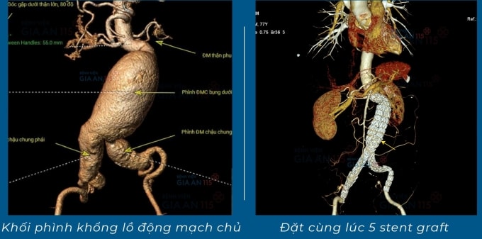 Hình ảnh mạch máu có túi phình (bên trái) và sau khi đăt stent (bên phải). Ảnh: Bệnh viện cung cấp