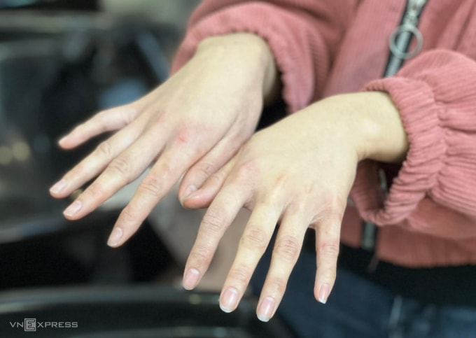 Tiếp xúc nhiều với nước và hóa chất, bàn tay nhân viên tiệm gội đầu thường bị nứt nẻ, đỏ ửng. Ảnh: Hồng Chiêu