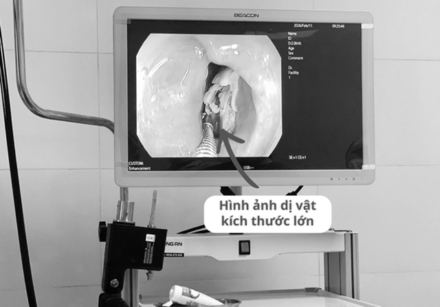 Đau họng, bác sĩ sốc phát biện bí mật "đáng sợ" bên trong - Ảnh 1.