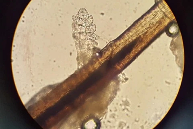 Người phụ nữ 24 tuổi khó chịu ở mí mắt, bác sĩ sốc khi gắp ra thứ "đáng sợ" chi chít trên mi- Ảnh 1. Người phụ nữ 24 tuổi khó chịu ở mí mắt, bác sĩ sốc khi gắp ra thứ "đáng sợ" chi chít trên mi- Ảnh 1.