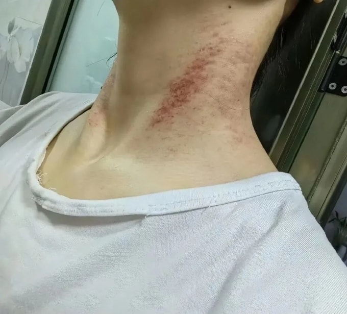 Vết thương trên cổ Đổng Văn. Ảnh: Phoenix Weekly