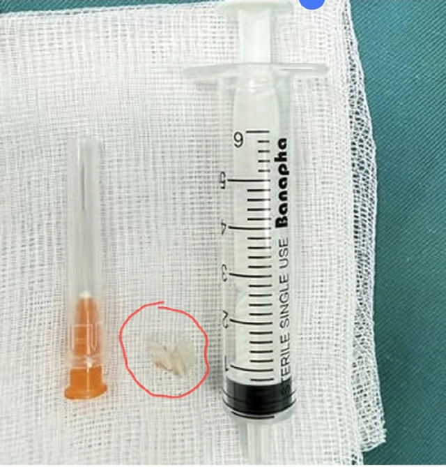 Bé trai 7 tuổi xẹp phổi trái, bác sĩ gắp ra thứ "đáng sợ" bên trong- Ảnh 1. Bé trai 7 tuổi xẹp phổi trái, bác sĩ gắp ra thứ "đáng sợ" bên trong- Ảnh 1.